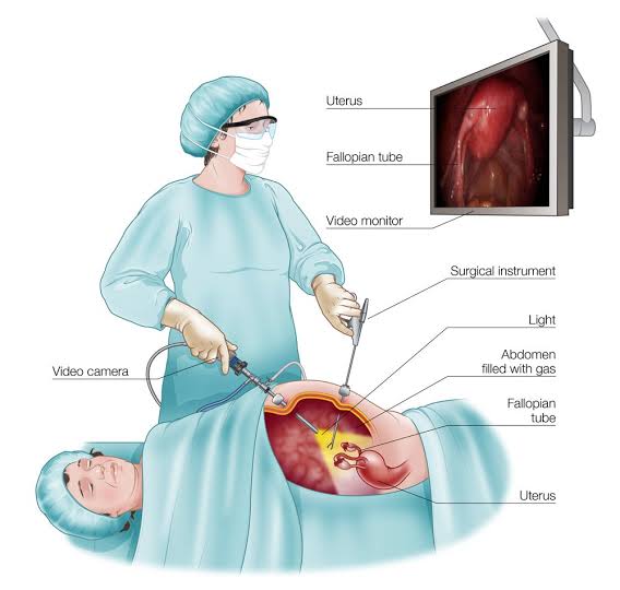 how-long-do-gas-pains-last-after-laparoscopy-at-milagros-bart-blog