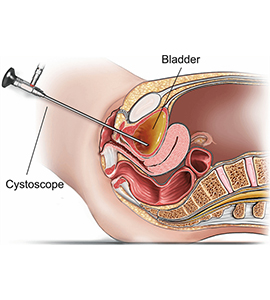 UROLOGICAL SURGERY SCOPES