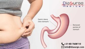 Read more about the article Laparoscopic Adjustable Gastric Banding (LAGB): obesity solution