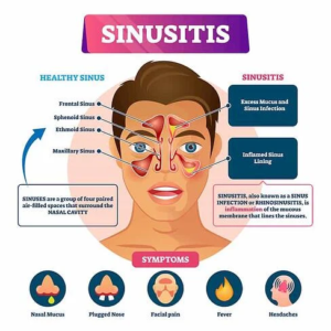 Read more about the article Get your sinuses ventilated: FESS