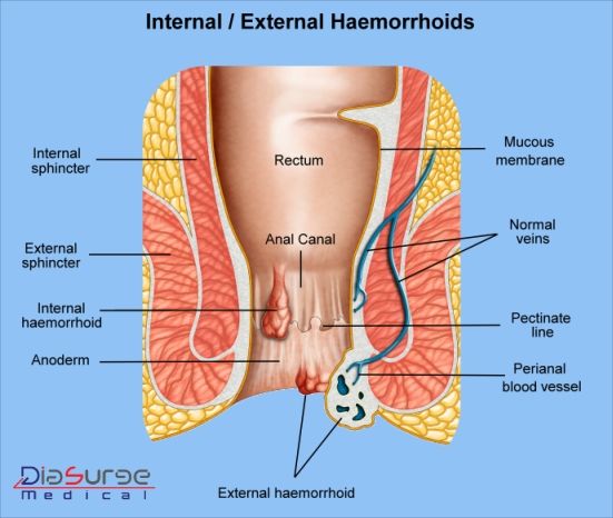 Read more about the article Minimal invasive surgery for hemorrhoids
