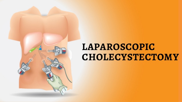 Read more about the article Laparoscopic cholecystectomy- the laparoscopic surgery for gallbladder removal